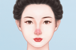 酒糟鼻治疗