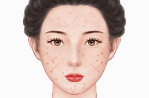 化学换肤
