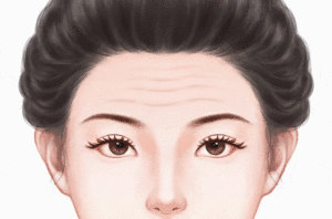 聚左旋乳酸去抬头纹