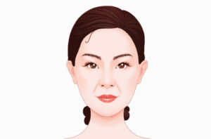 聚左旋乳酸去法令纹