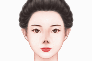 鼻尖缺损修复