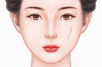 瘢痕修复