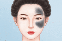 去除太田痣