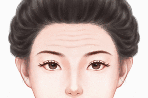 激光去抬头纹