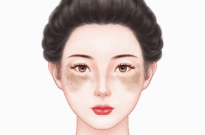 激光祛晒斑