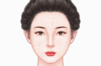 激光祛痘疤
