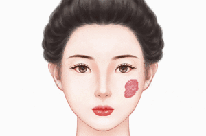 激光治疗血管瘤