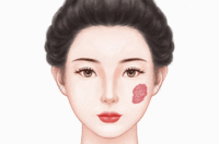 治疗血管瘤