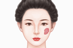 治疗血管瘤
