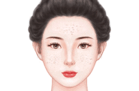果酸焕肤祛痘疤