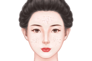 果酸焕肤祛痘疤