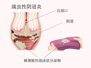 滴虫性阴道炎