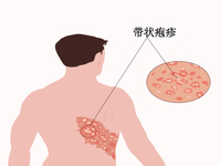 带状疱疹