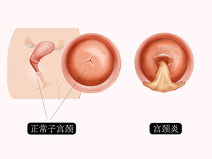 宫颈炎