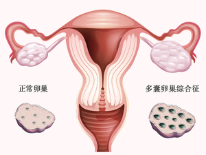 多囊卵巢综合征