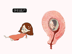 流产