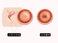 宫颈囊肿