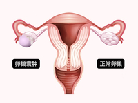 卵巢囊肿
