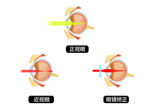 近视