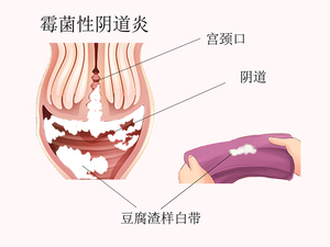 霉菌性阴道炎