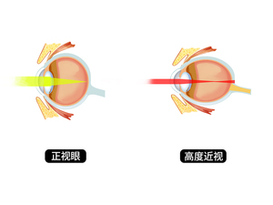 高度近视