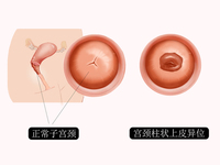 宫颈柱状上皮异位