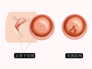 宫颈息肉