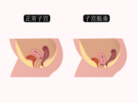 子宫脱垂