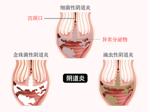 阴道炎