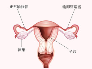 输卵管堵塞