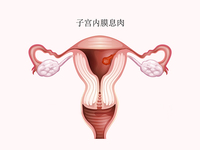 子宫内膜息肉