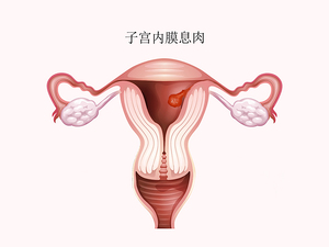 子宫内膜息肉
