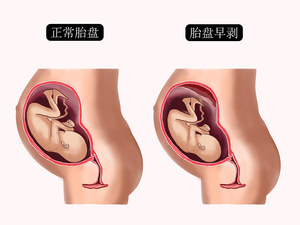 胎盘早剥
