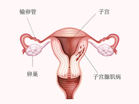子宫腺肌病