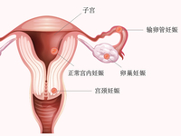 异位妊娠