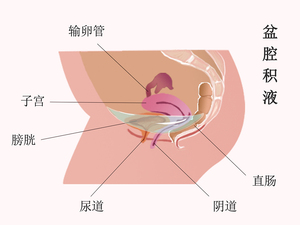 盆腔积液