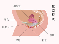 盆腔积液