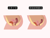 阴道前壁膨出