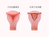 子宫内膜增生