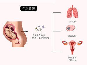 羊水栓塞