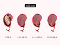 前置胎盘