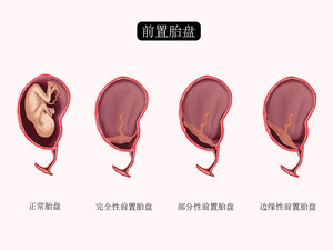 前置胎盘