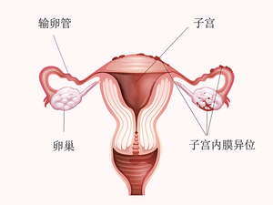 子宫内膜异位症