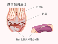 细菌性阴道炎