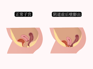 阴道前后壁膨出