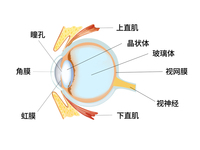 玻璃体混浊