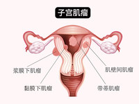 子宫肌瘤
