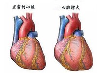 心脏增大
