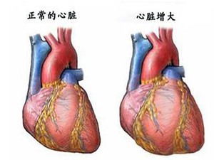 心脏增大