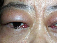 皮下捻发音